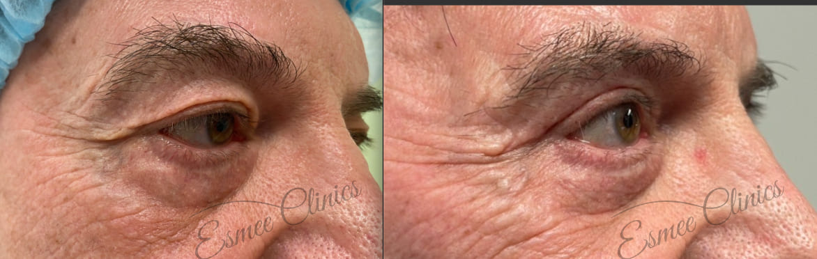 Before and After img